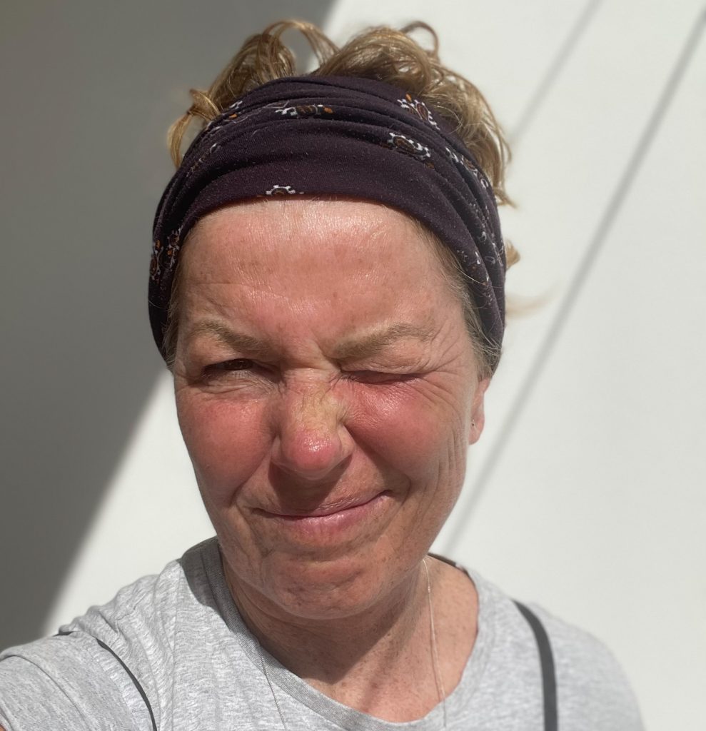 sånt jag har glömt att ta med på resan, malin lundskog, solbränd i sagres
